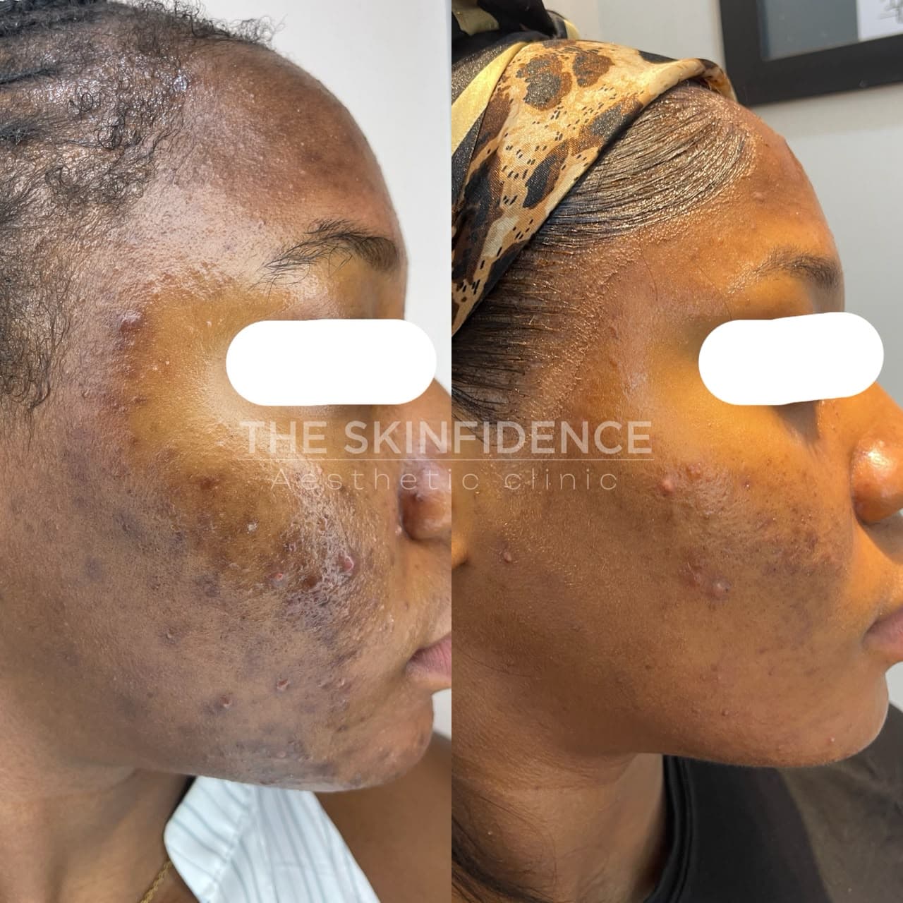 [ 02 · BEFORE / AFTER · ACNE · TEXTURE ]