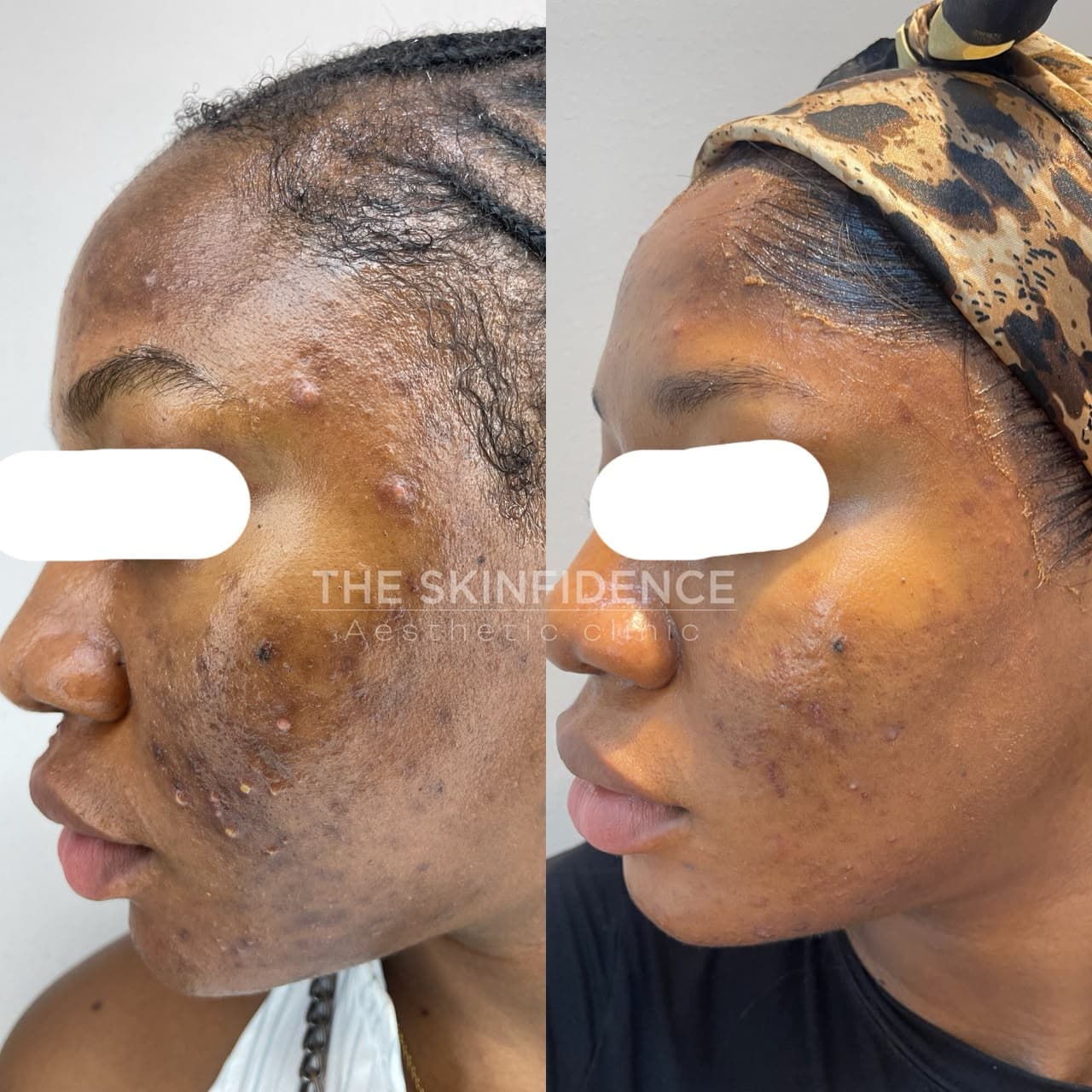 [ 03 · BEFORE / AFTER · ACTIVE ACNE · PIH ]