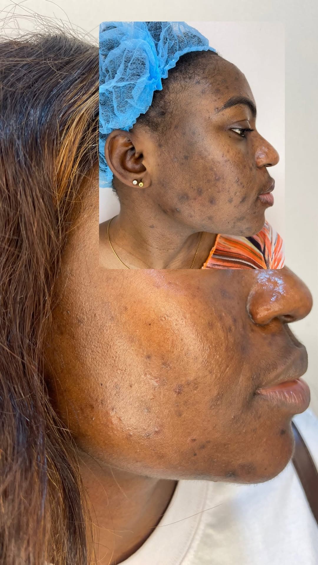 [ 02 · CHEMICAL PEEL COURSE ]