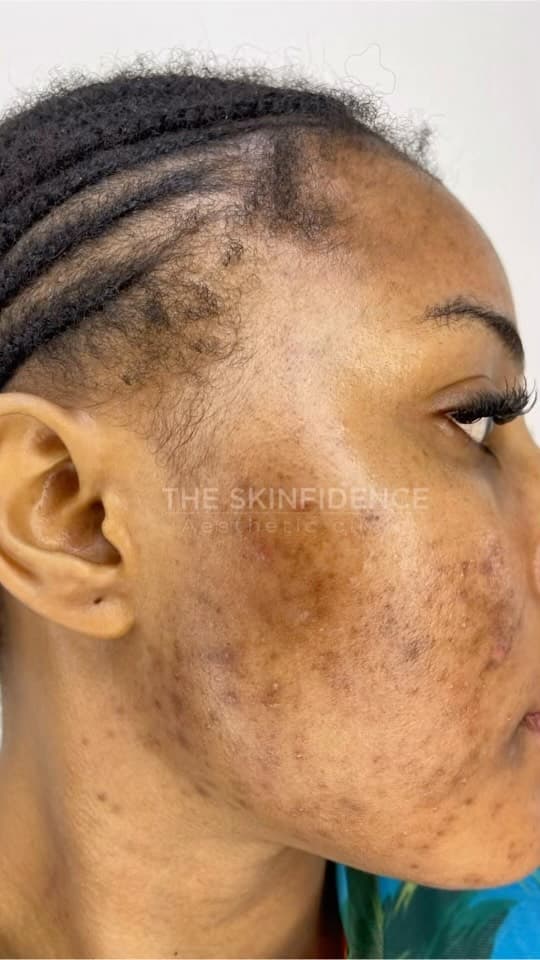 [ 05 · ACNE & SCARRING ]