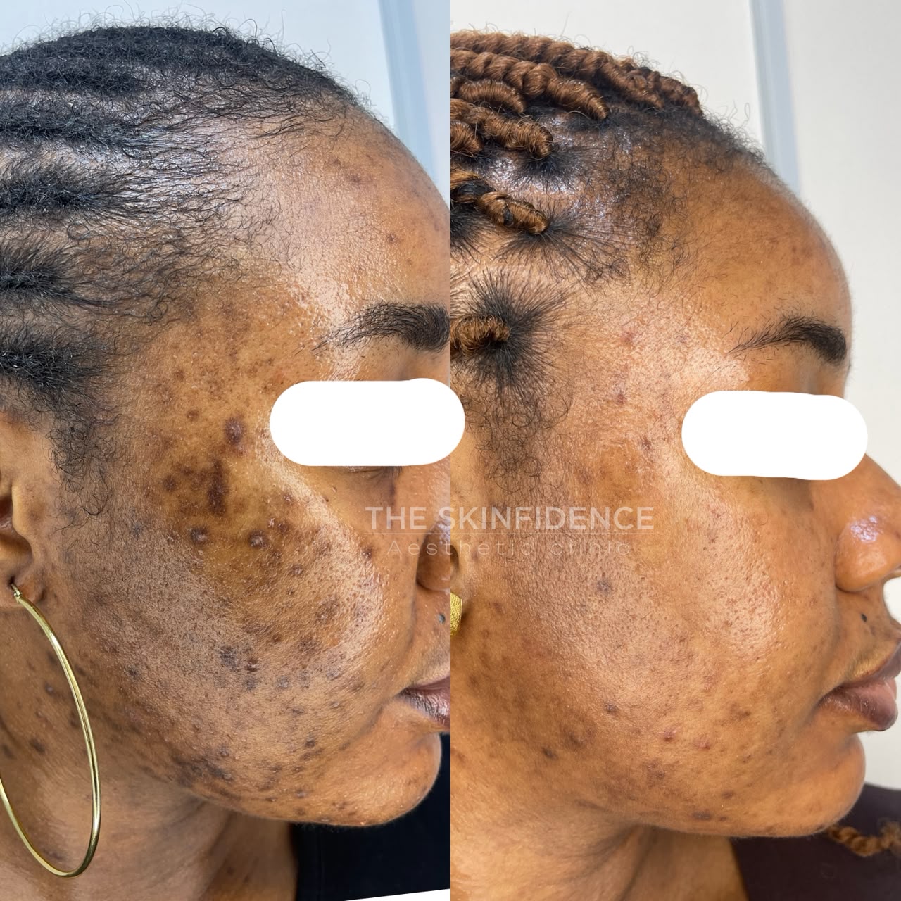 Real Skinfidence client before and after a hyperpigmentation plan
