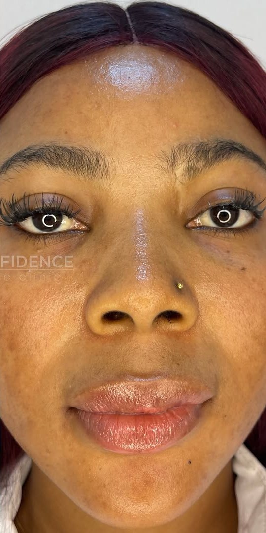 Real Skinfidence client before and after treatment