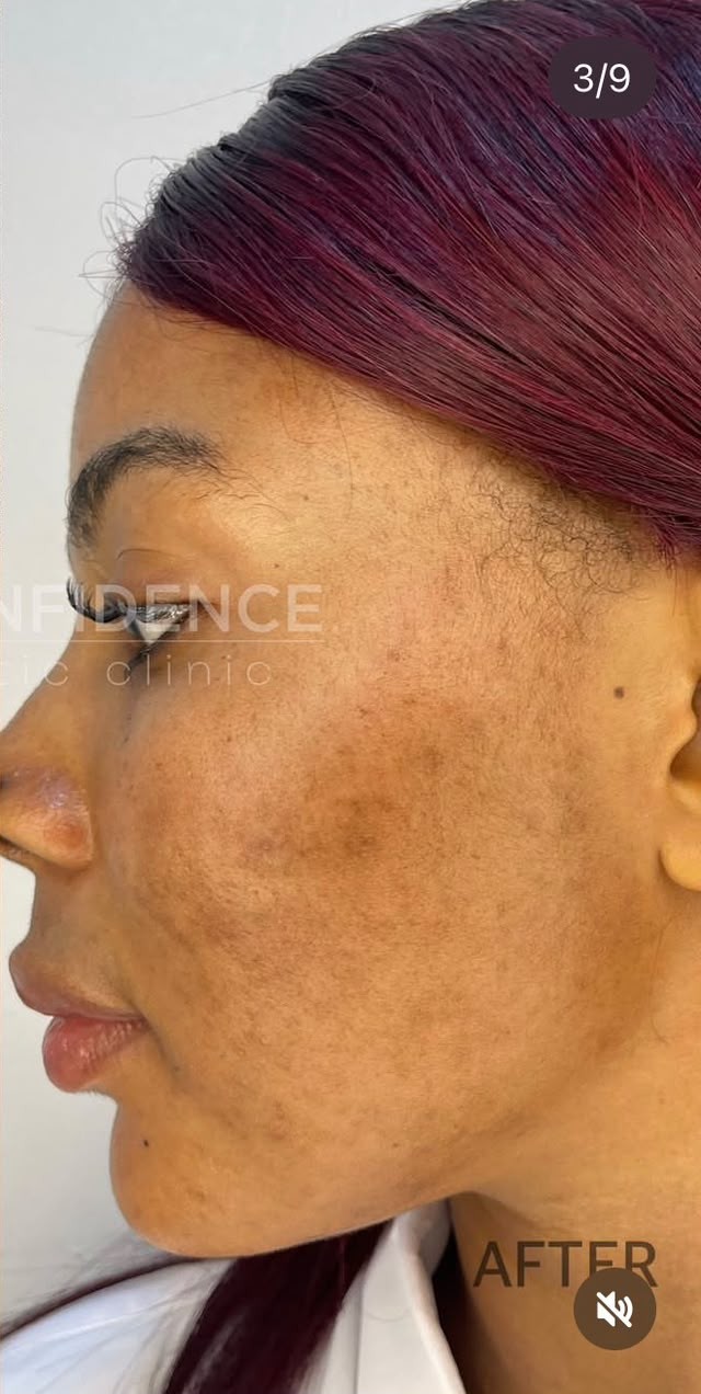 Real Skinfidence client before and after treatment, side profile